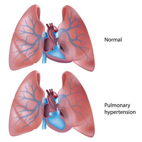 Pulmonary Hypertension Lungs